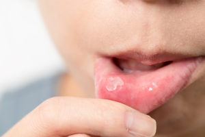 長引く口内炎に注意してほしい「舌がん」とは
